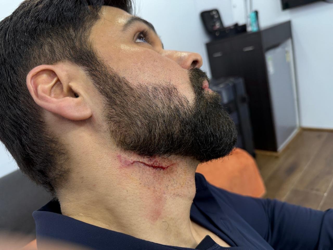 Emraan Hashmi Injured On Goodachari 2 Set In Hyderabad